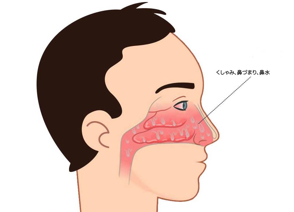 allergic-thinitis